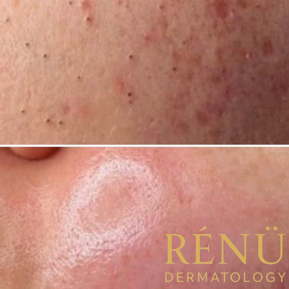 Teenage Acne Treatment in Lymington: The Complete Guide