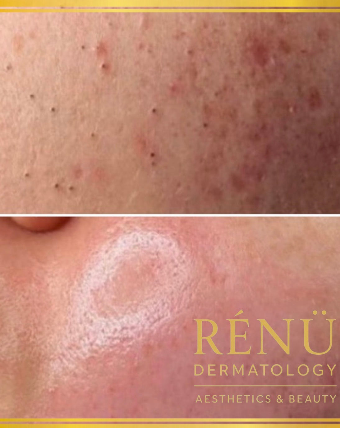 Teenage Acne Treatment in Lymington: The Complete Guide