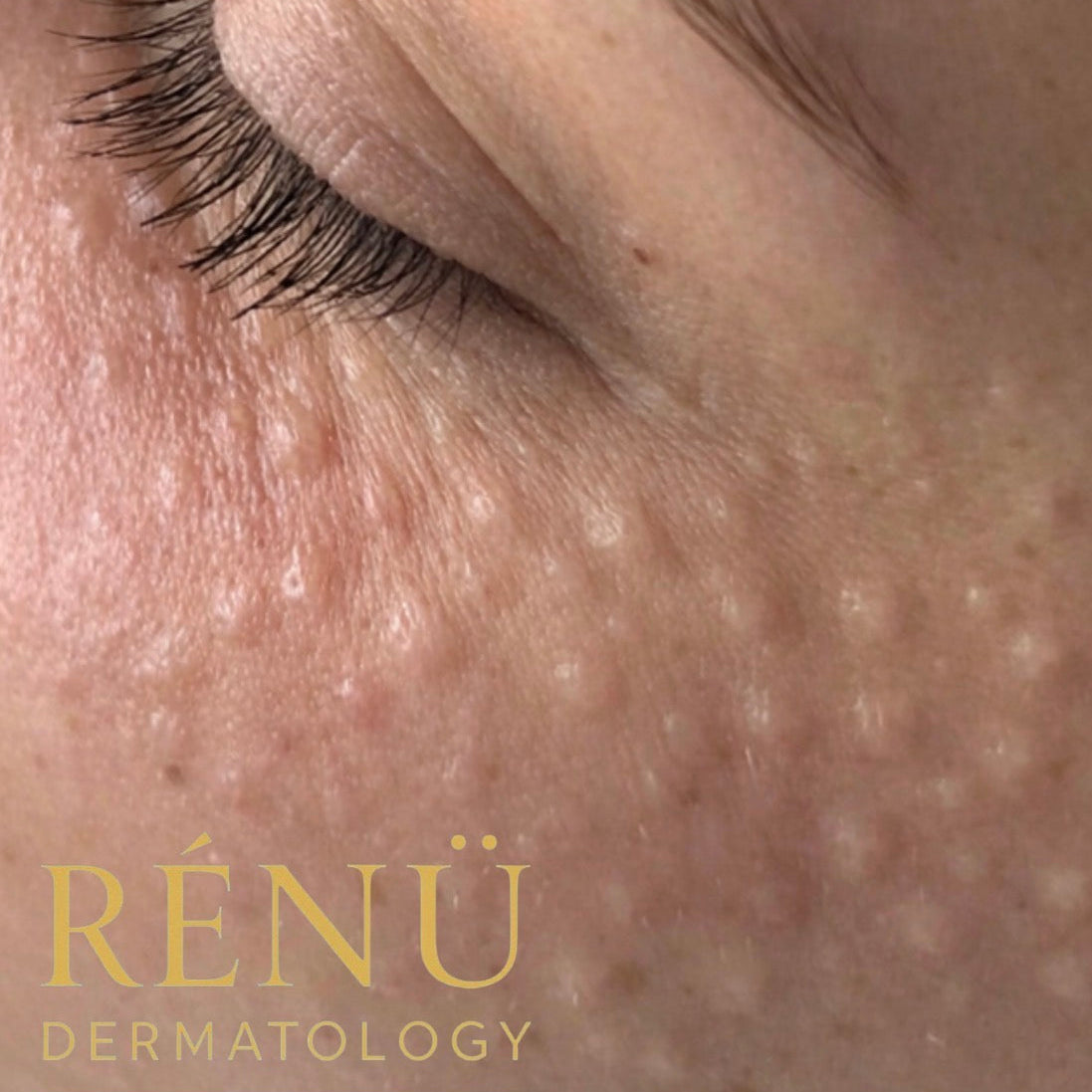 Skin Boosters Near Me: The Ultimate Guide to Hydrated, Youthful Skin in Lymington &amp; The New Forest