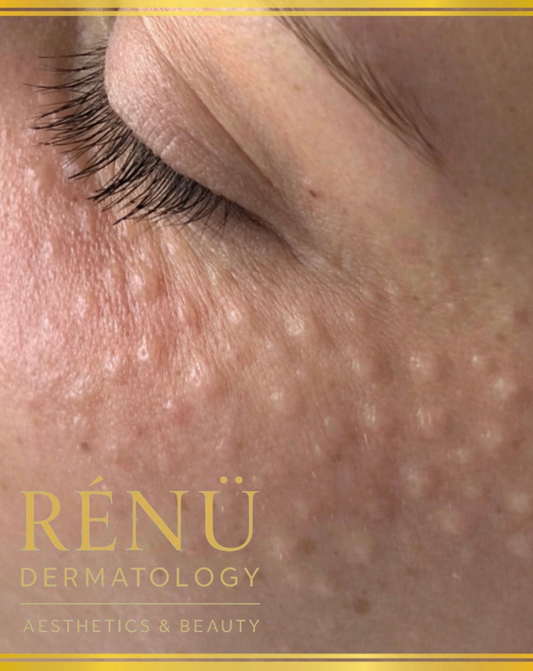 Skin Boosters Near Me: The Ultimate Guide to Hydrated, Youthful Skin in Lymington & The New forest