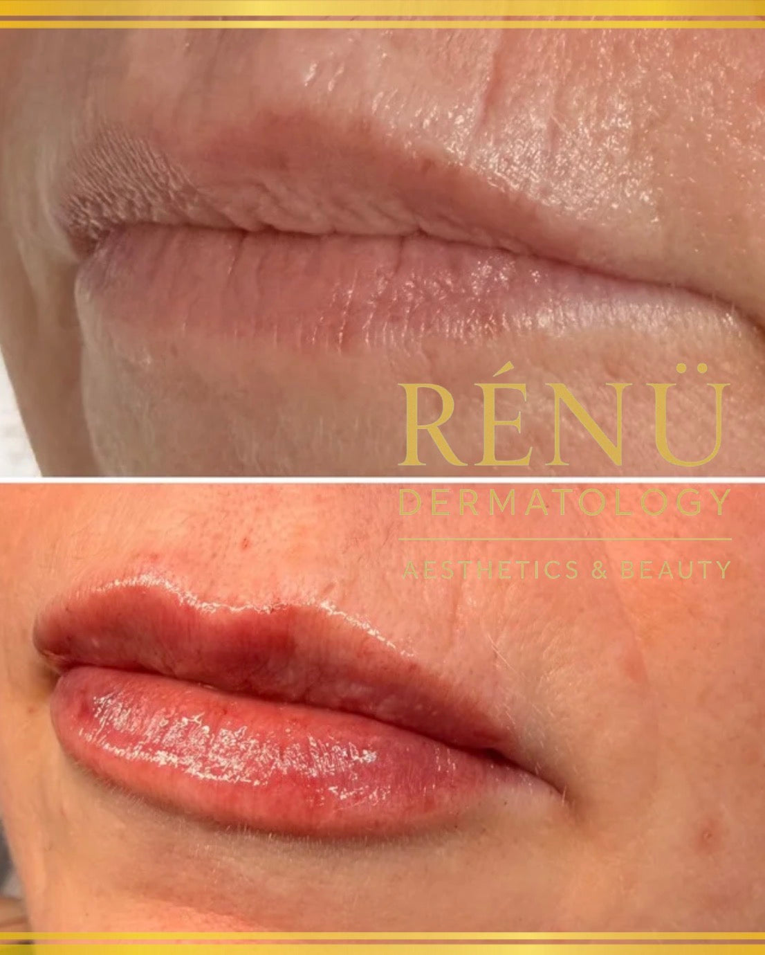 lip-filler-near-me-lymington-renu-dermatology.jpg