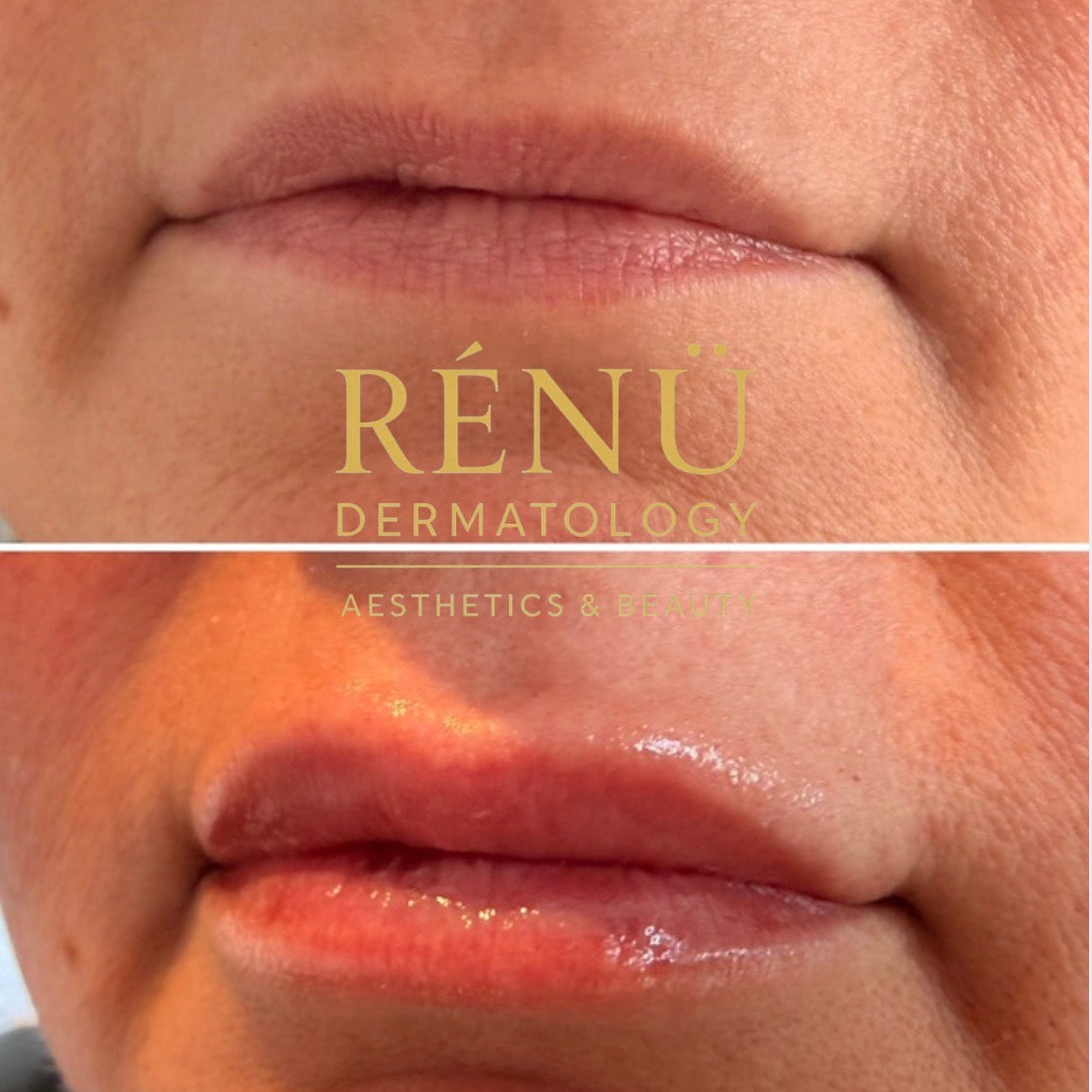 Lip filler near me 