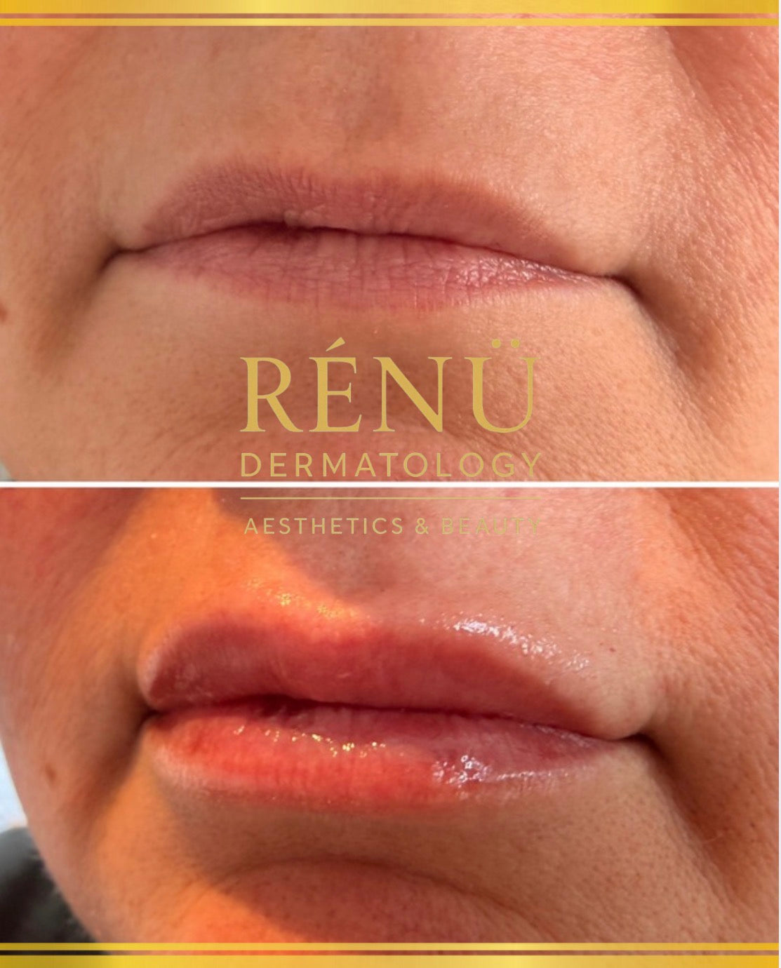Lip filler near me 