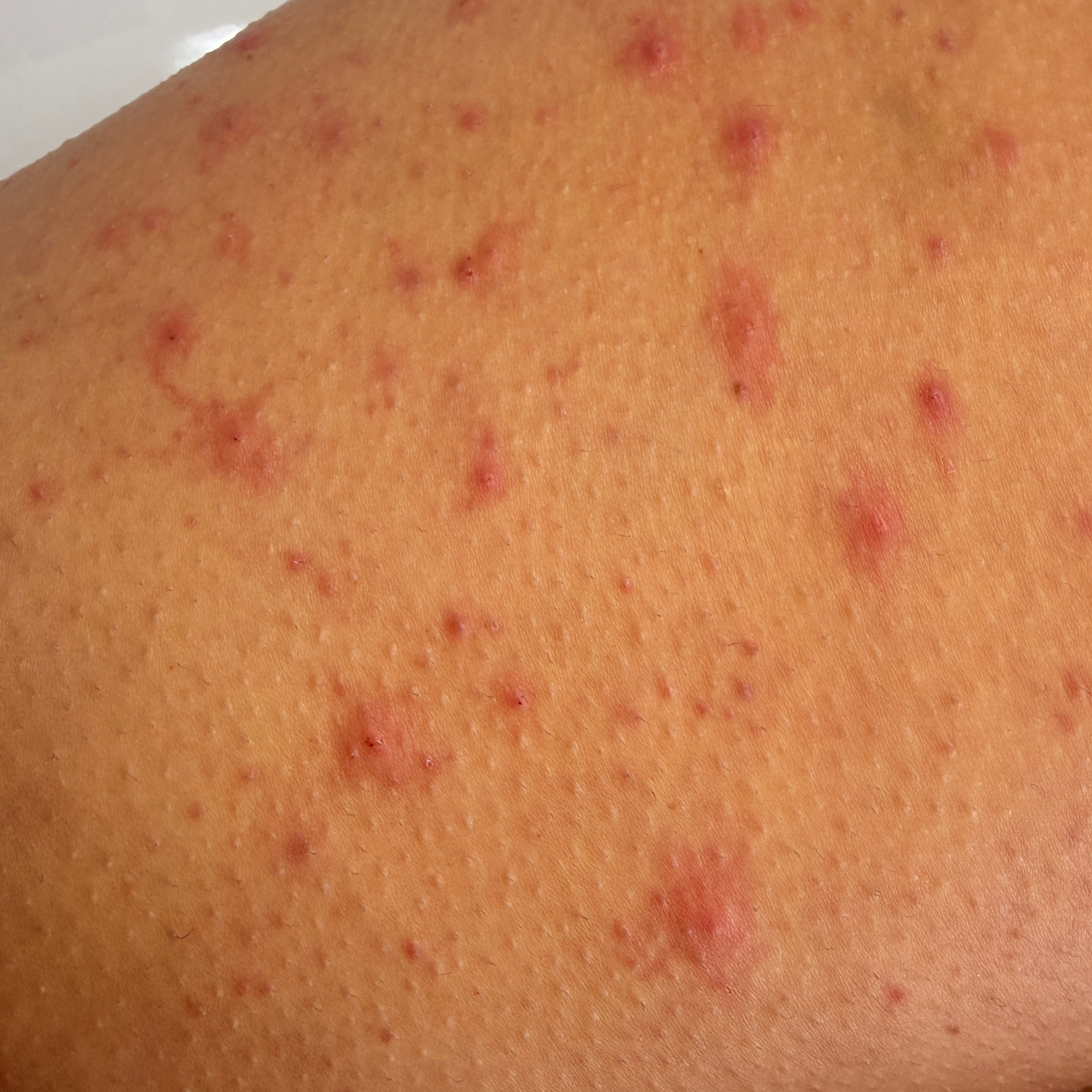 microneedling-lymington-renu-dermatology.jpg