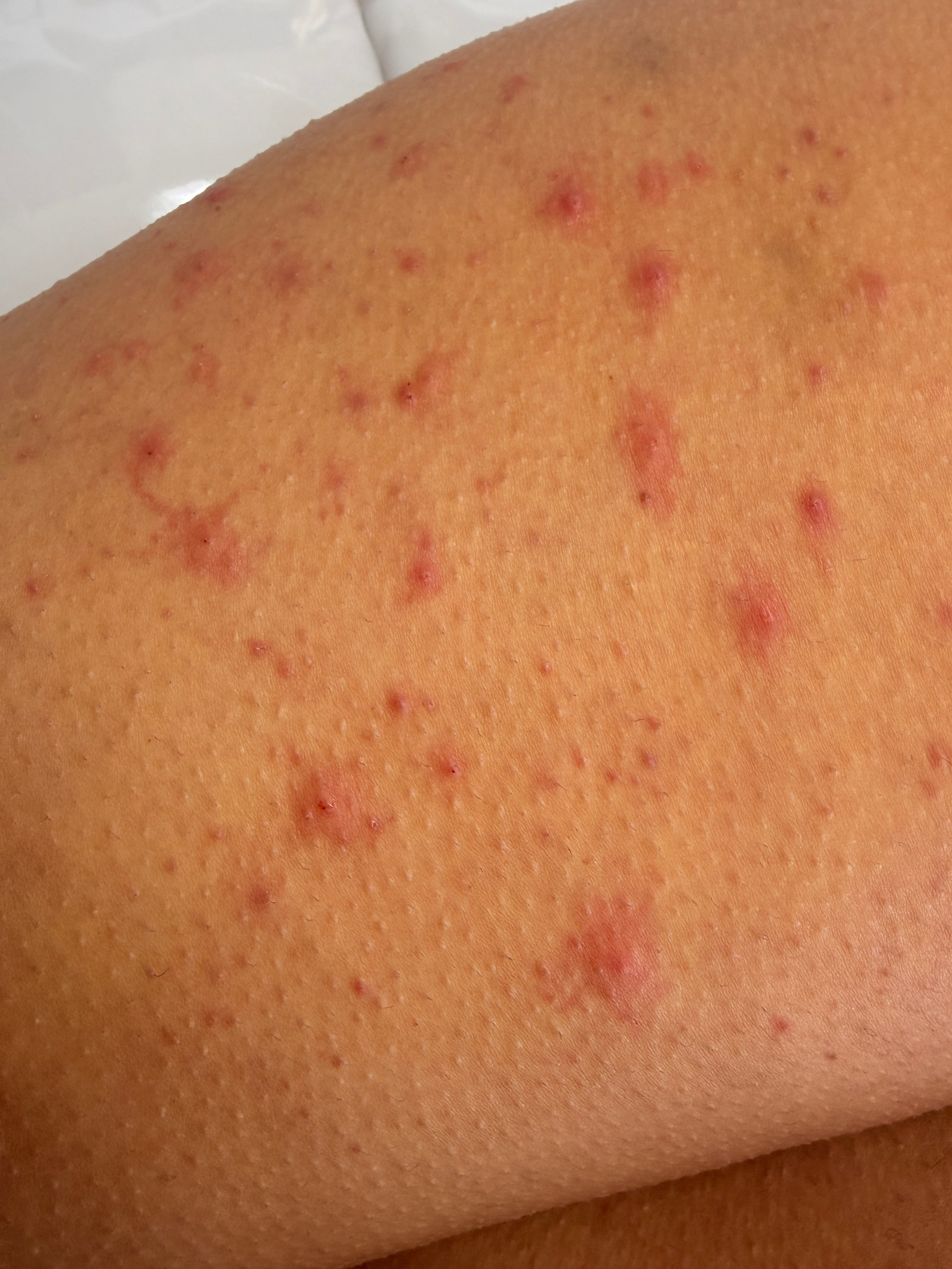 microneedling-lymington-renu-dermatology.jpg