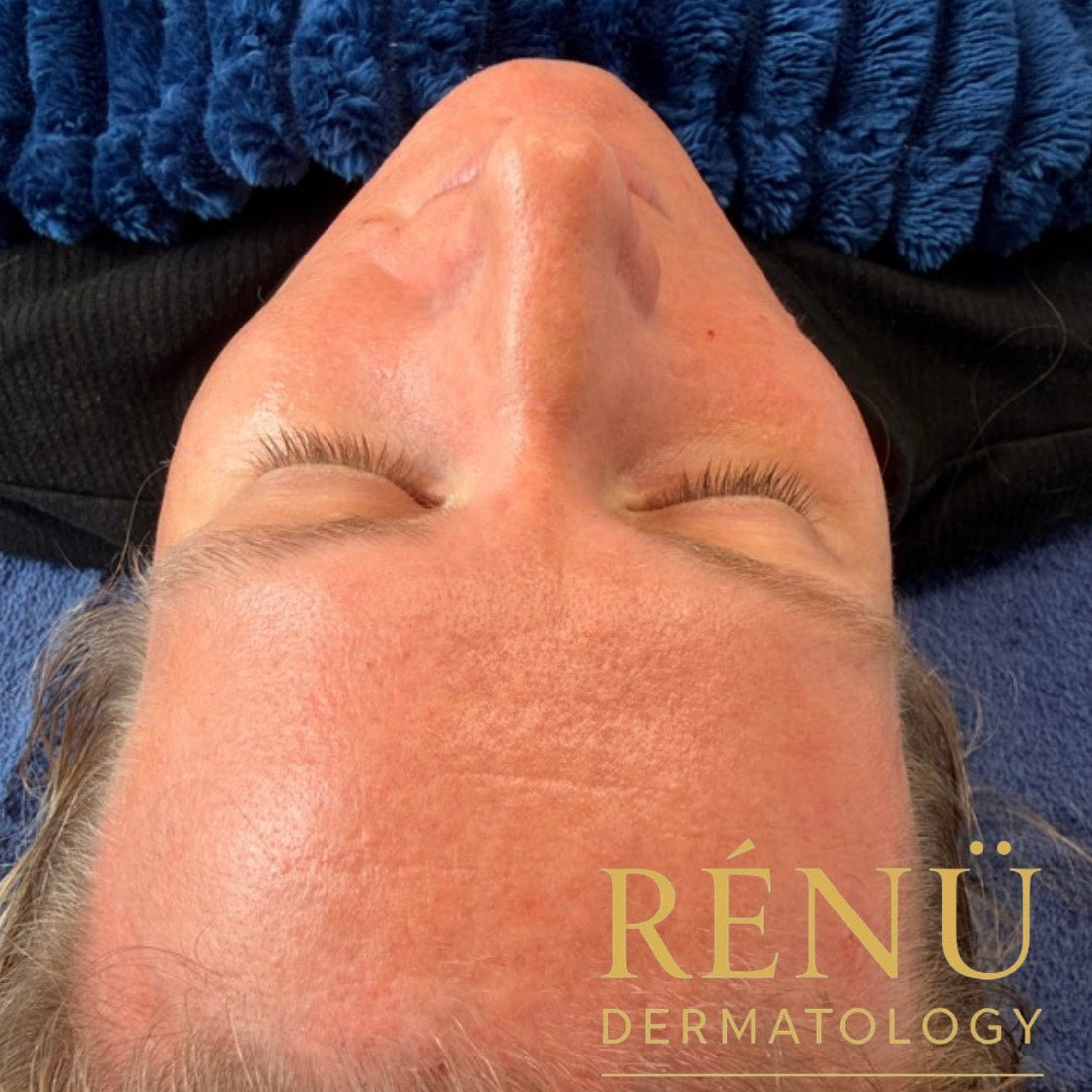 Advanced skin treatments in Lymington including microneedling, hydrafacial and skin boosters at Rènü Dermatology