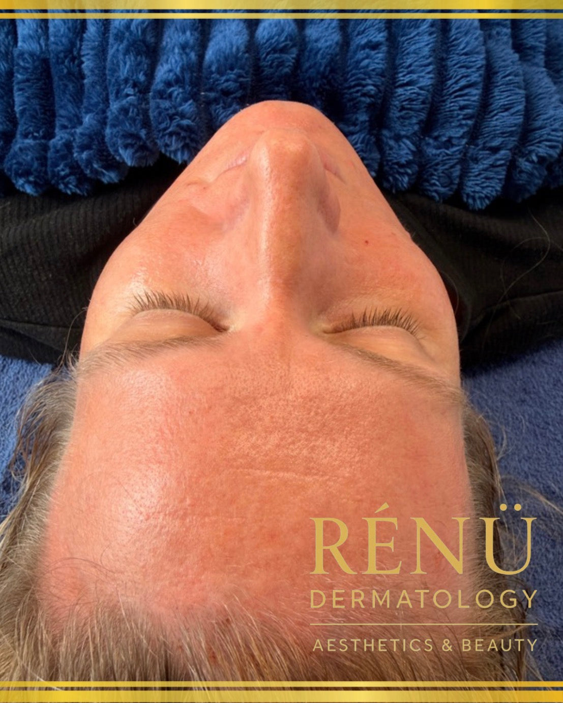 Advanced skin treatments in Lymington including microneedling, hydrafacial and skin boosters at Rènü Dermatology