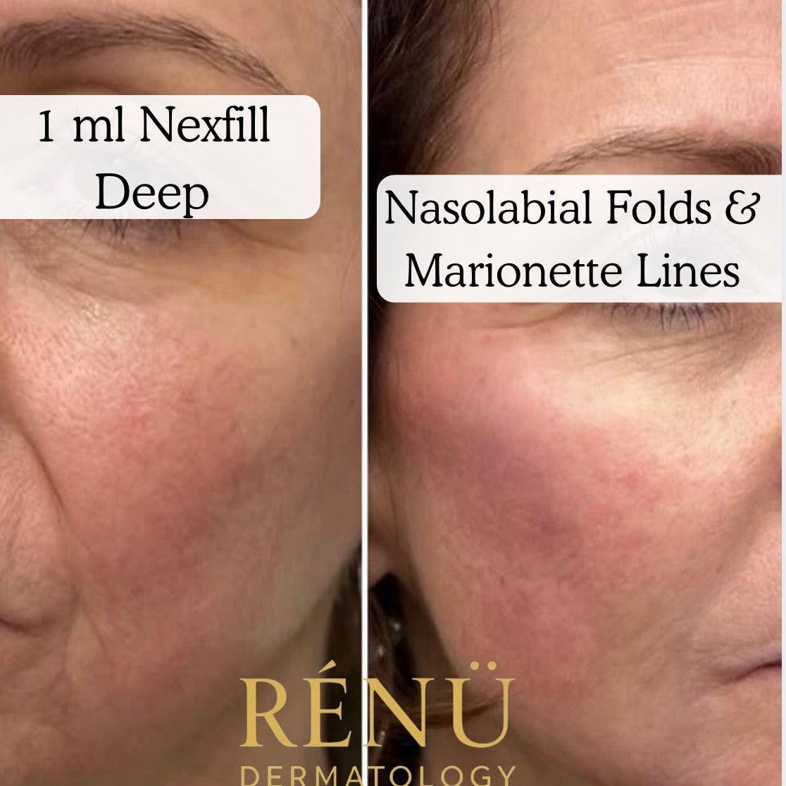 Advanced Skin Treatments in Lymington: The Ultimate Guide by Rènü Dermatology