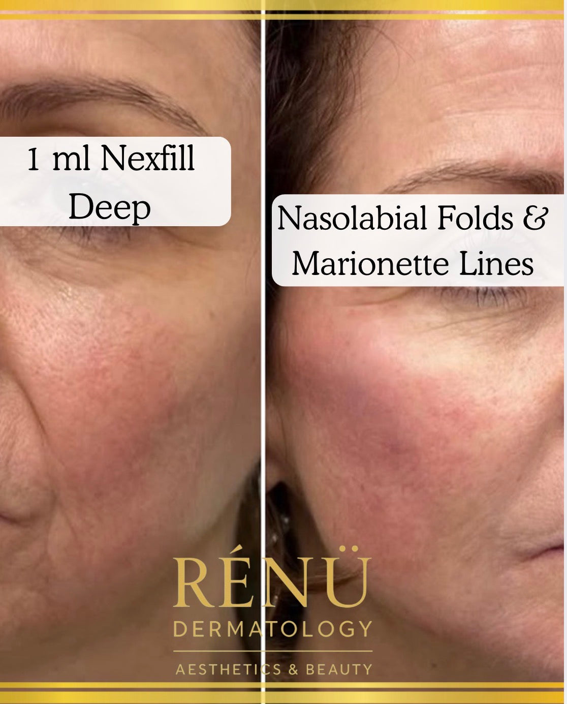 Advanced Skin Treatments in Lymington: The Ultimate Guide by Rènü Dermatology