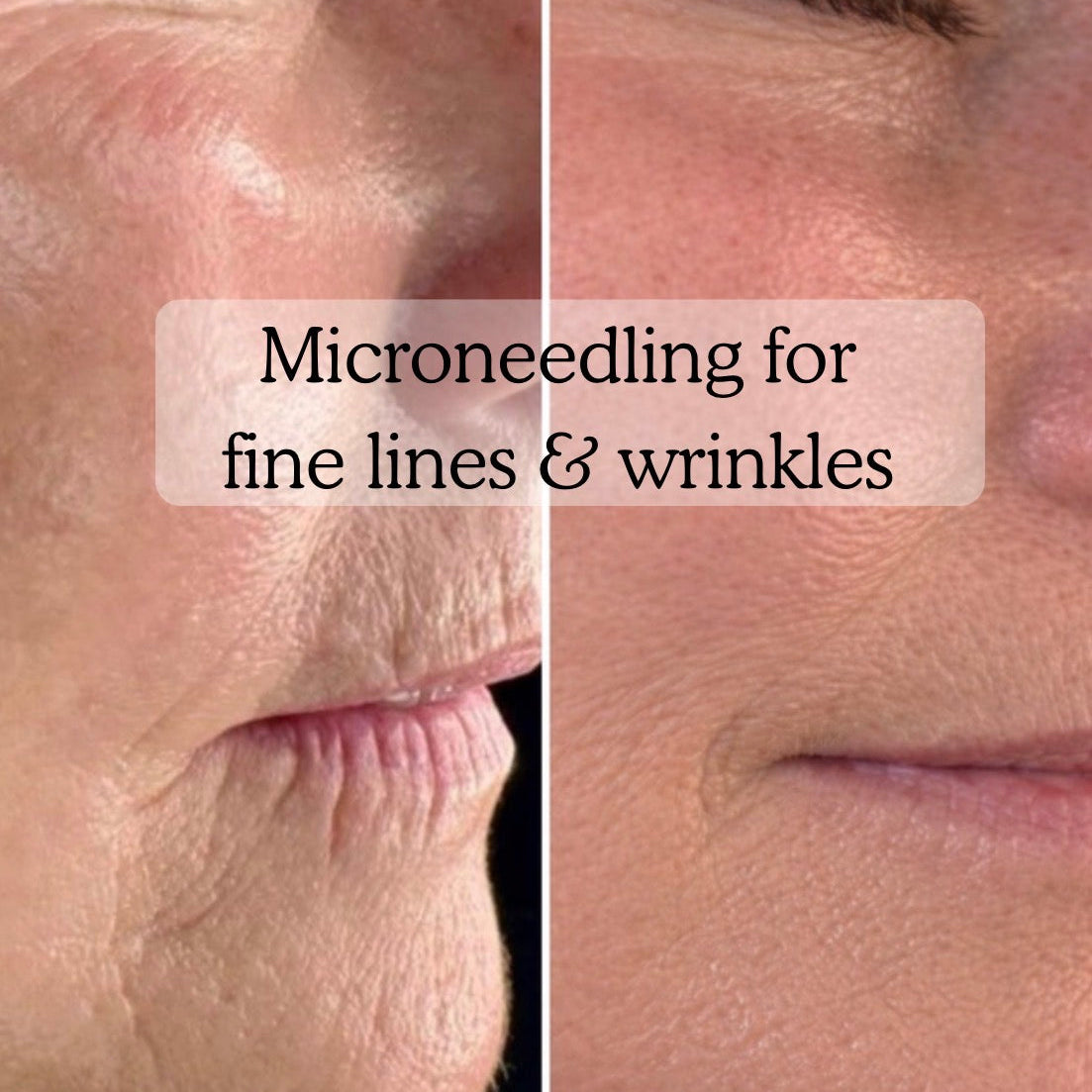 Aesthetic skin treatments at Rènü Dermatology in Lymington including microneedling and skin boosters