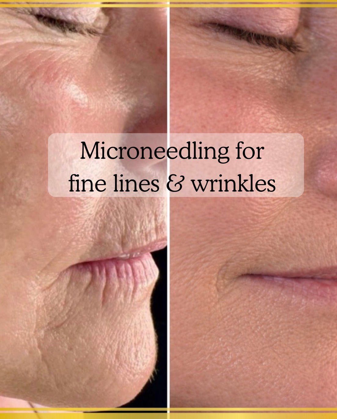 Aesthetic skin treatments at Rènü Dermatology in Lymington including microneedling and skin boosters
