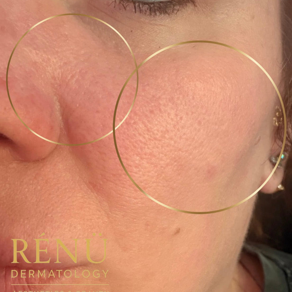 Skin Treatments in Lymington: The Ultimate Guide to Glowing, Youthful Skin at Rènü Dermatology