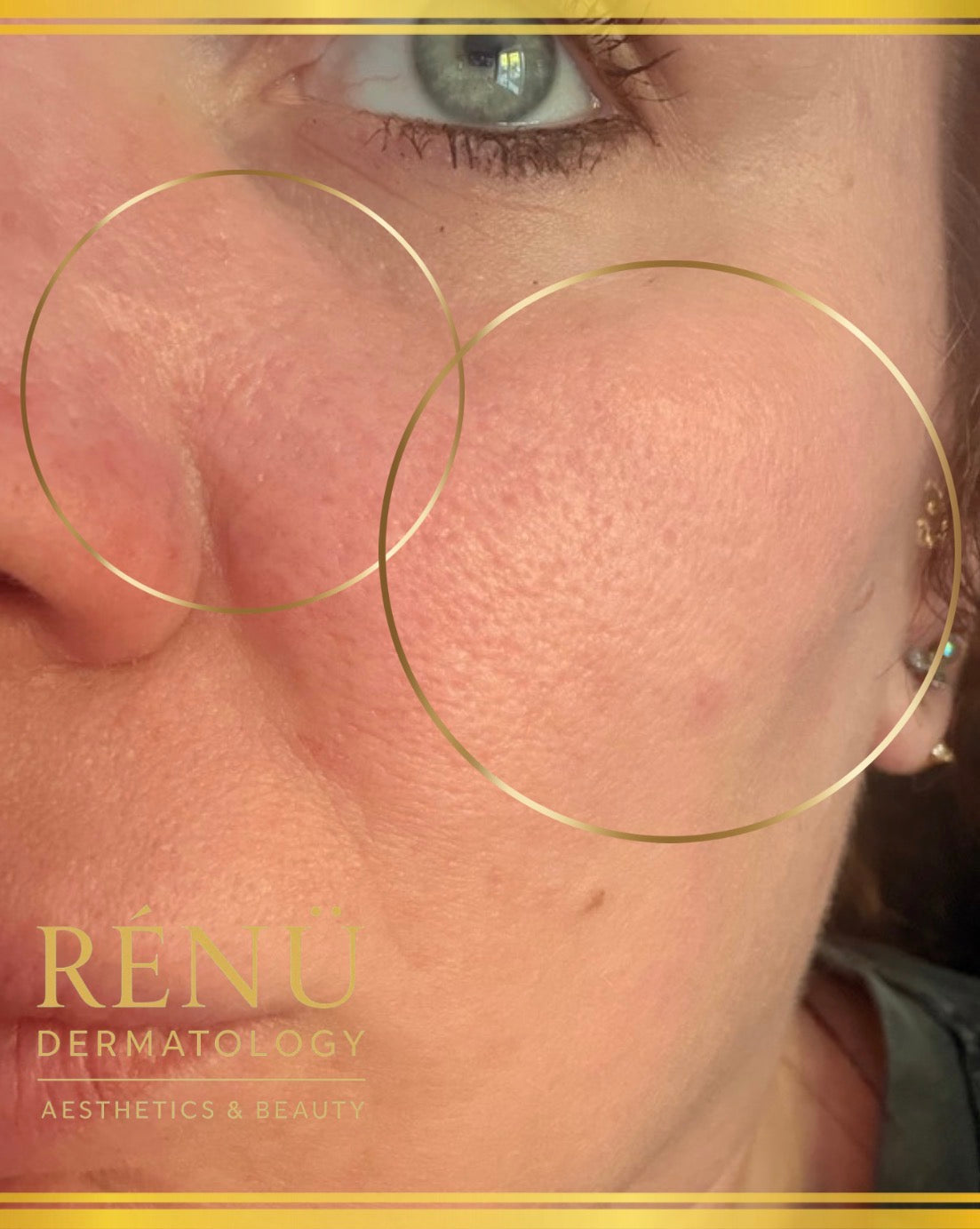 Skin Treatments in Lymington: The Ultimate Guide to Glowing, Youthful Skin at Rènü Dermatology