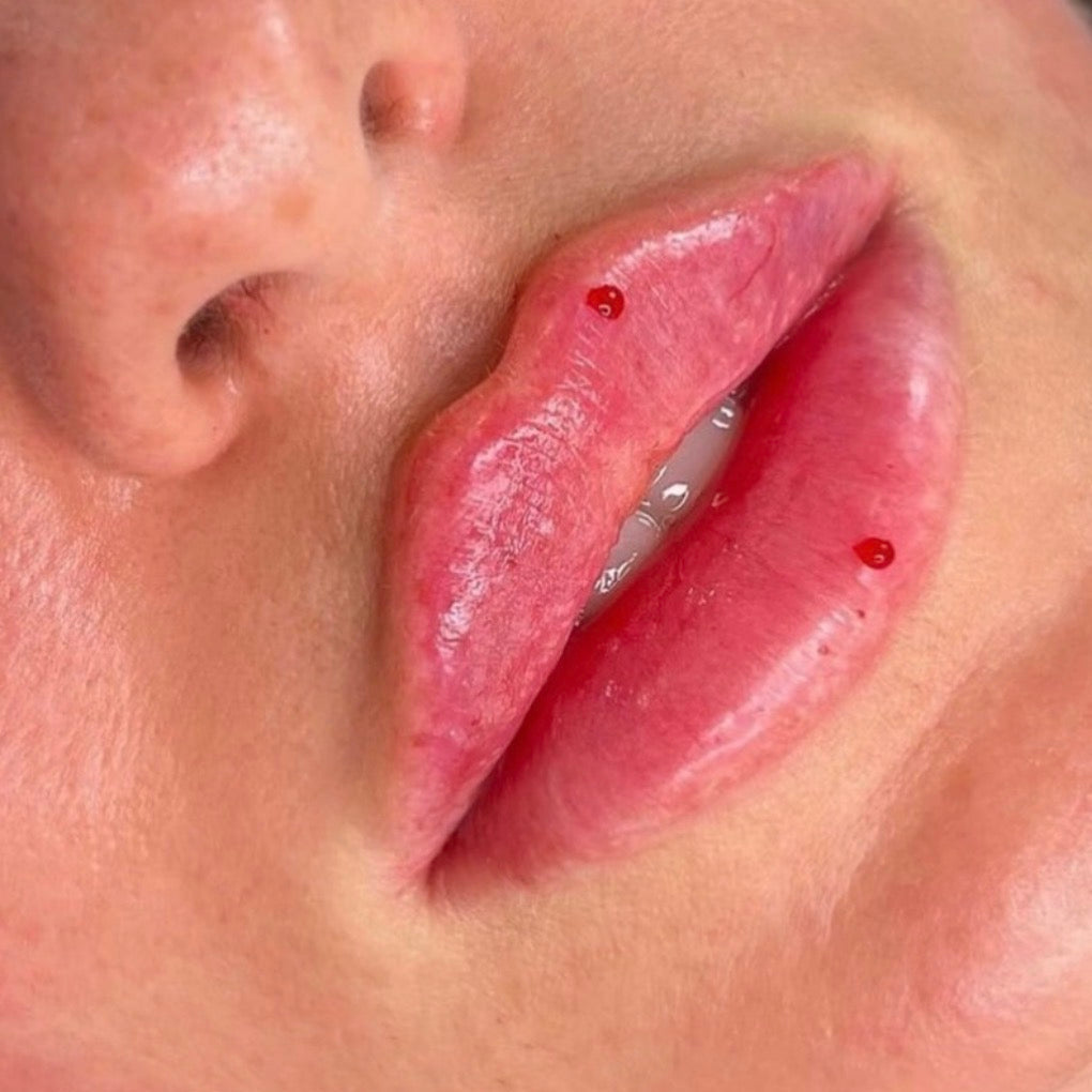 The Ultimate Guide to Dermal Lip Fillers: Types, Techniques & The Different Lip Looks They Create