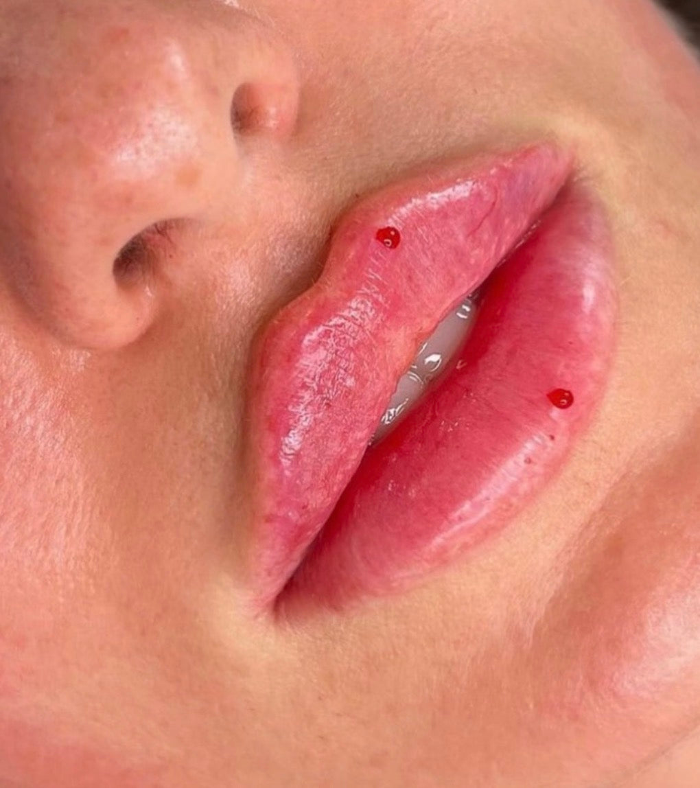 The Ultimate Guide to Dermal Lip Fillers: Types, Techniques & The Different Lip Looks They Create