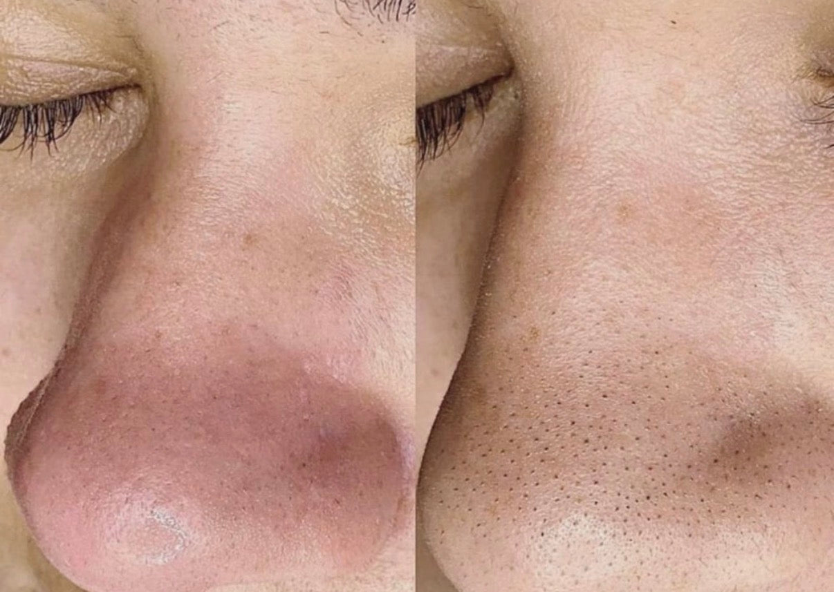 The Complete Guide to Hydrodermabrasion Facials in Lymington