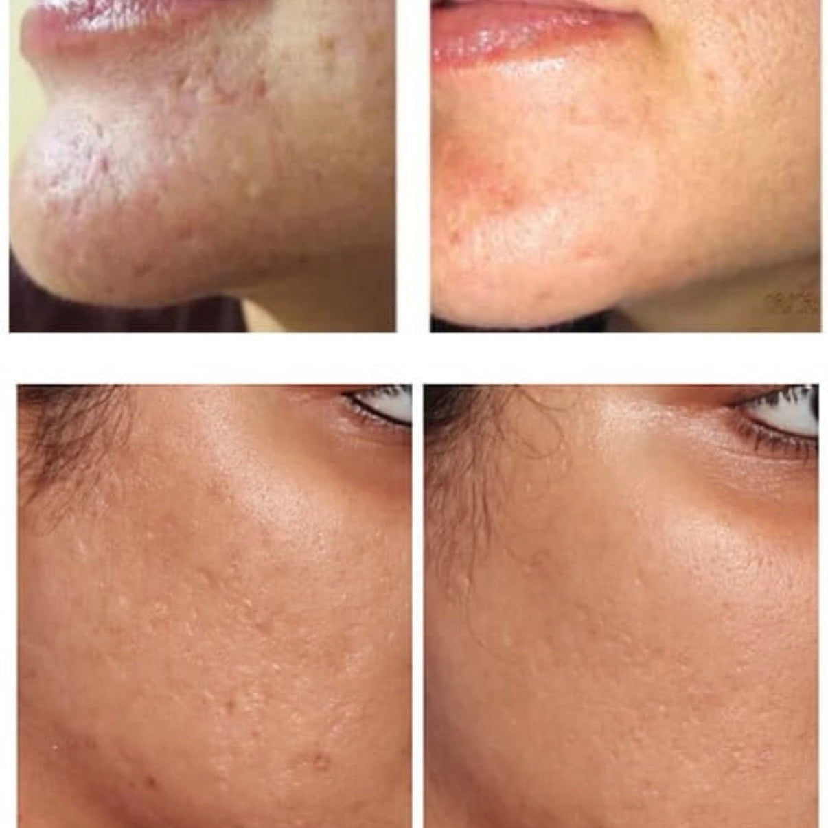 How Microneedling Can Help Reduce Surgical Scars  A Non-Surgical Solution for Smoother, Healthier Skin