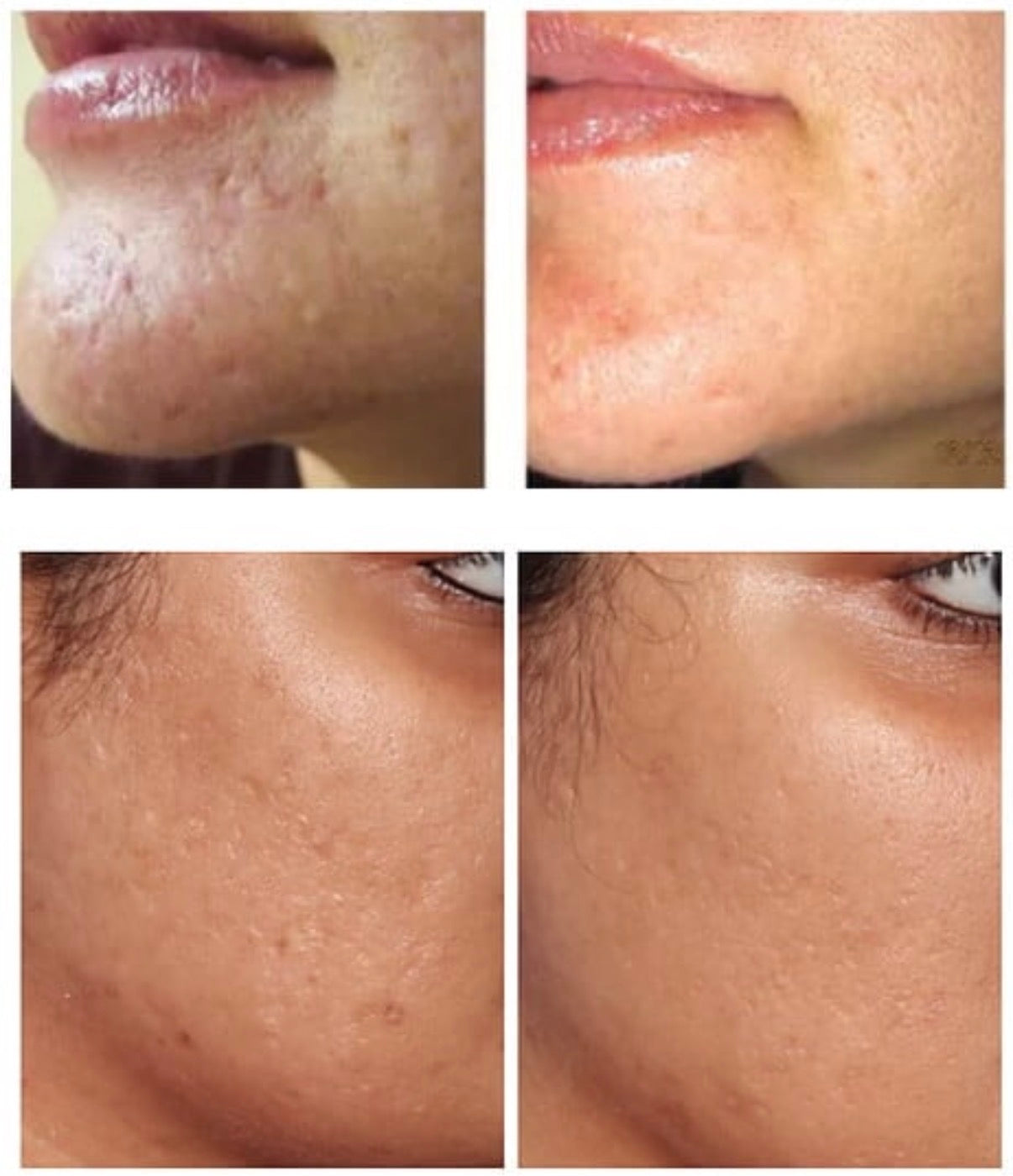 How Microneedling Can Help Reduce Surgical Scars  A Non-Surgical Solution for Smoother, Healthier Skin