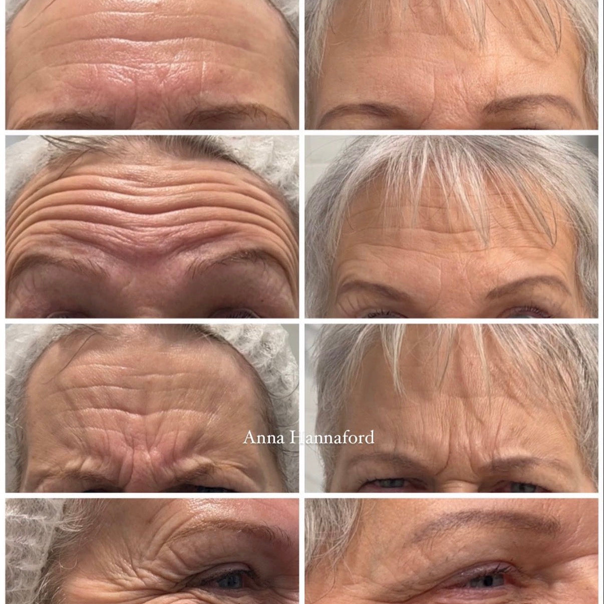 Polynucleotides & Anti-Wrinkle Injections:  The Ultimate Combination for Smoother Forehead Lines in Lymington