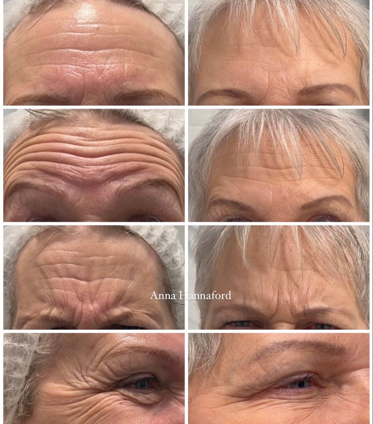Polynucleotides & Anti-Wrinkle Injections:  The Ultimate Combination for Smoother Forehead Lines in Lymington