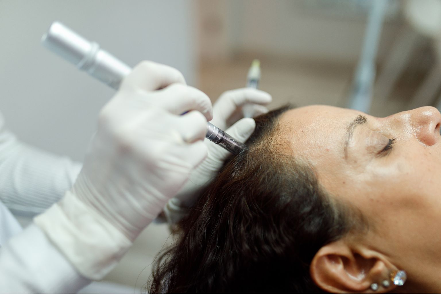 Microneedling for Hair Loss: How It Works & Why It’s One of the Most Effective Treatments