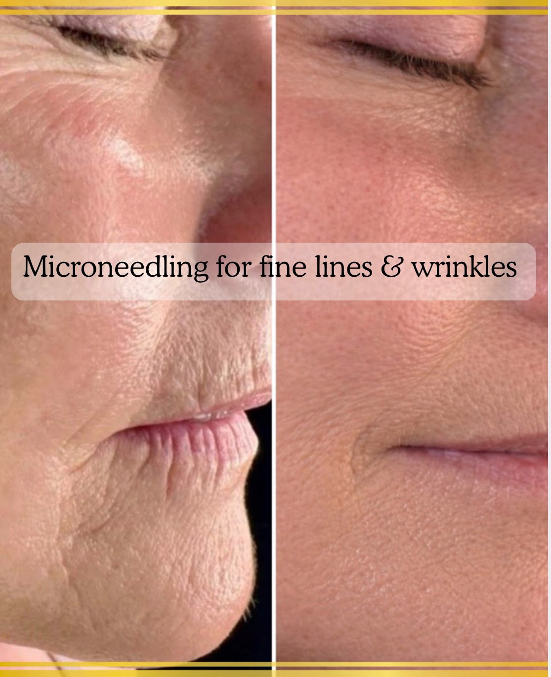 Microneedling in Lymington &amp; the New Forest: Benefits, Results &amp; What to Expect