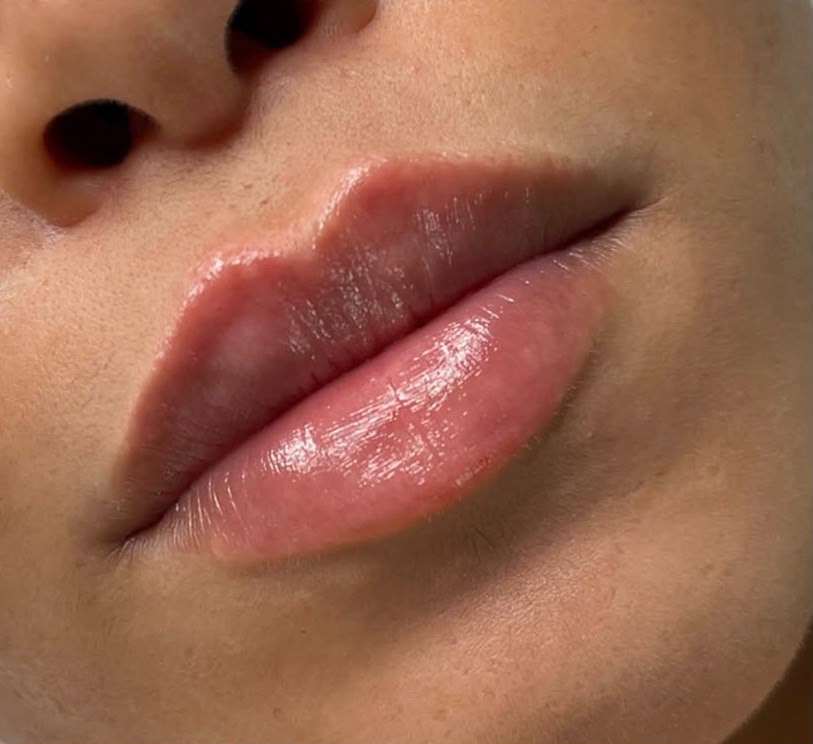 Lip Filler Near Me: Natural-Looking Lip Filler in Lymington