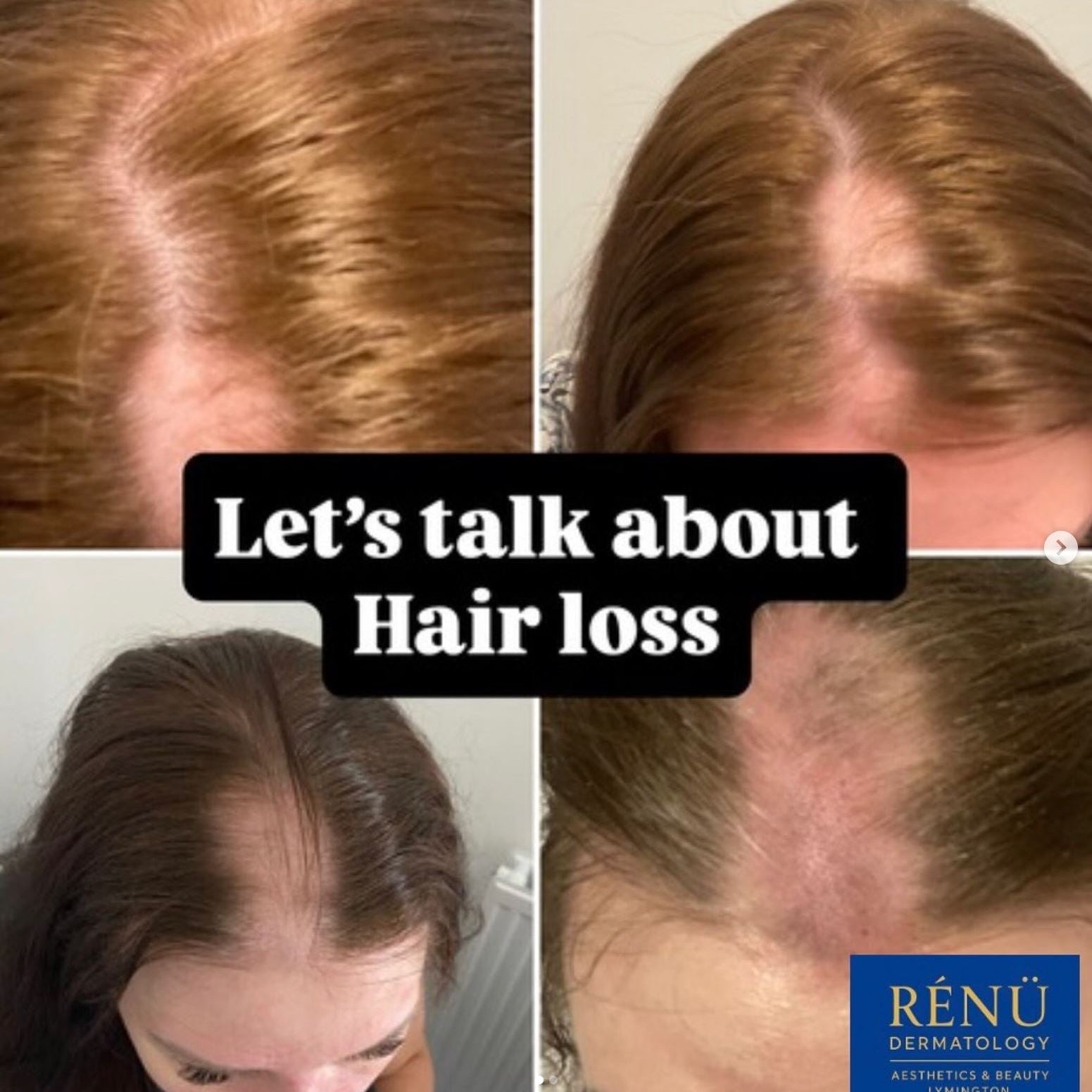 Advanced Scalp Microneedling, LED Therapy &amp; Hair Recovery in Lymington