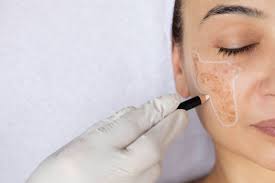 The Ultimate Guide to Microneedling: Benefits, Results & Why Your Skin Will Love It
