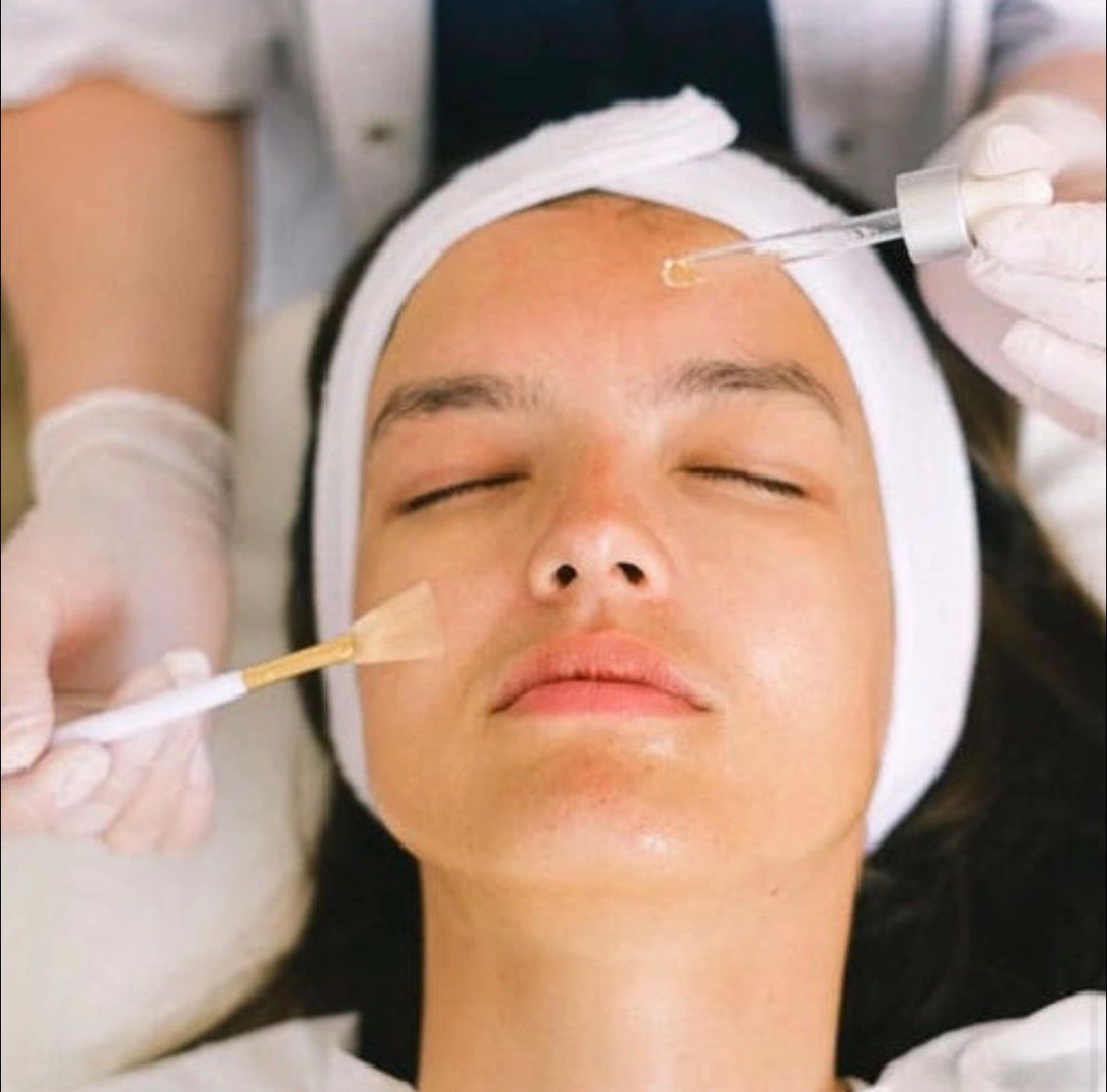 Chemical peel treatment in Lymington improving skin texture and radiance at Rènü Dermatology