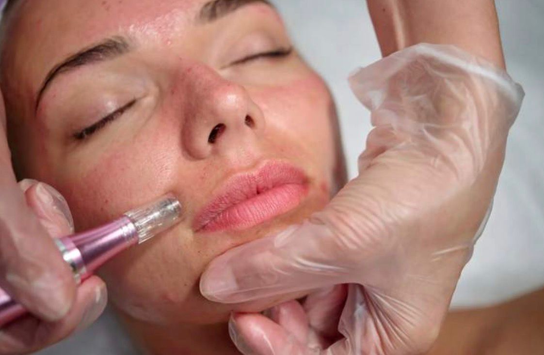 Advanced microneedling treatment in Lymington stimulating collagen and skin rejuvenation at Rènü Dermatology
