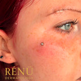 Dermal Anchor Piercing