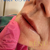 Mature Lip Filler in Lymington – Natural Lip  Rejuvenation