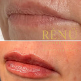 0.5ml Lip Filler – Natural Lip Enhancement