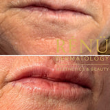 Mature Lip Filler in Lymington – Natural Lip  Rejuvenation