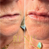 Mature Lip Filler in Lymington – Natural Lip  Rejuvenation