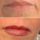 0.5ml Lip Filler – Natural Lip Enhancement
