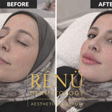 1.1ml Lip Filler in Lymington – Natural Lip Enhancement