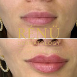 1.1ml Lip Filler in Lymington – Natural Lip Enhancement