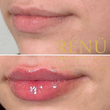 1.1ml Lip Filler in Lymington – Natural Lip Enhancement