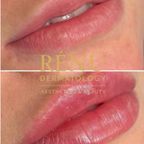 1.1ml Lip Filler in Lymington – Natural Lip Enhancement