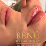 0.5ml Lip Filler – Natural Lip Enhancement