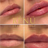 1.1ml Lip Filler in Lymington – Natural Lip Enhancement