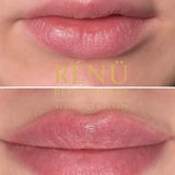 1.1ml Lip Filler in Lymington – Natural Lip Enhancement