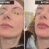 1.1ml Lip Filler in Lymington – Natural Lip Enhancement