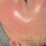 Nano Needling in Lymington – Gentle Skin Rejuvenation