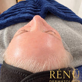 Nano Needling in Lymington – Gentle Skin Rejuvenation