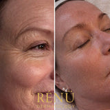 Meso-Tox Microneedling in Lymington