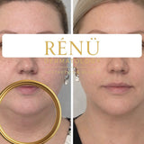 Aqualyx Fat Dissolving in Lymington