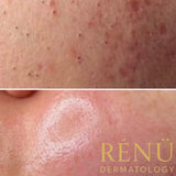 Teen Acne & Congestion Facial